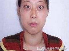 甲亢病人怎么保护身体,甲亢保护眼睛戴什么眼镜