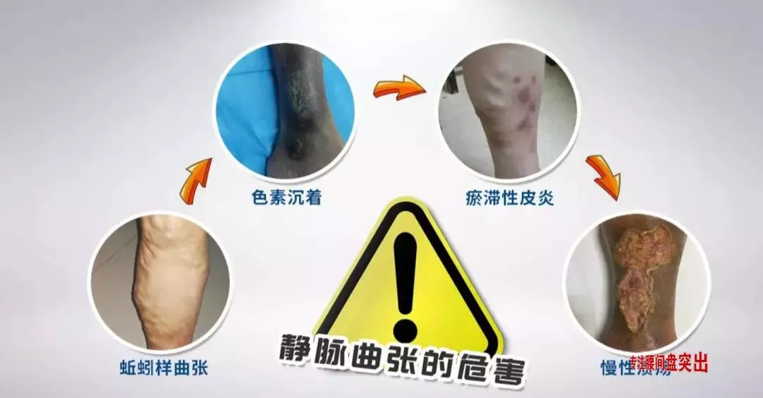 腿部网状静脉曲张的最快消除方法,怎样治静脉曲张和蚯蚓腿
