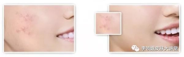 「杏林微资讯」打击痘印，趁早行动！