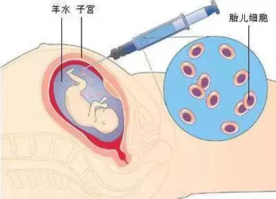 后悔没做脐带血穿刺,没做羊水穿刺担心唐氏儿