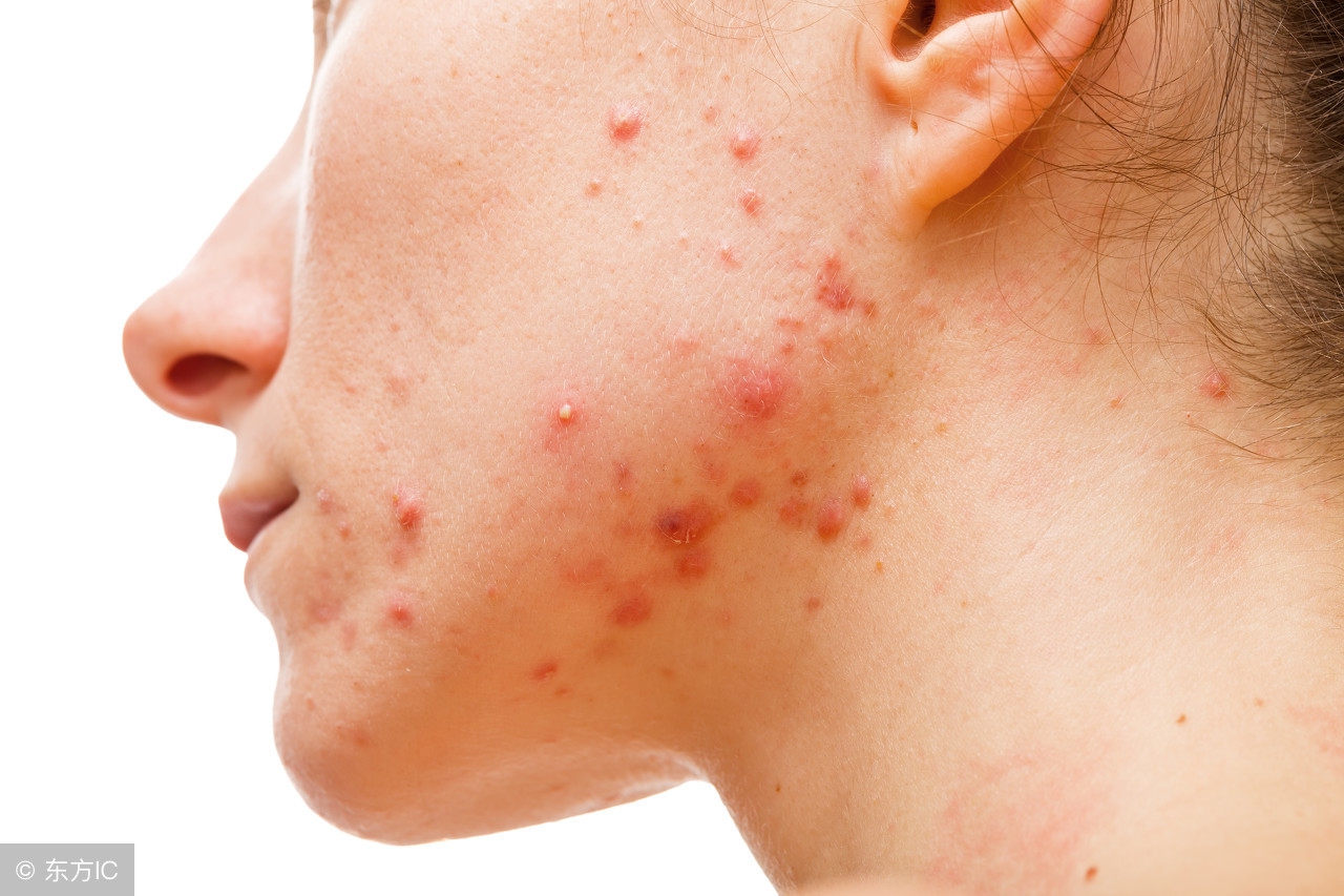 脸上长几个痘可以吃异维a酸吗,口服异维a酸爆痘后怎么办