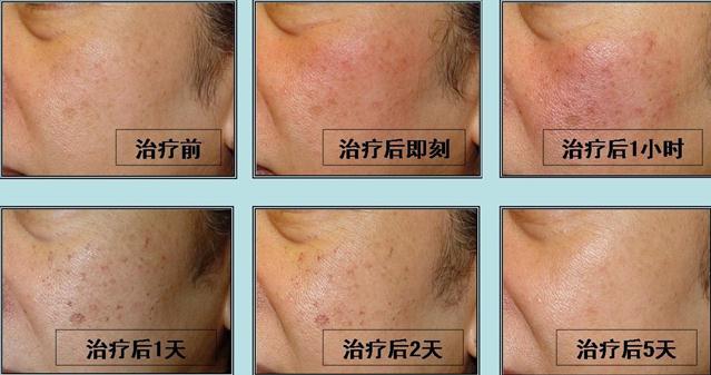 我脸上有很多色斑打激光能治好吗,我脸上的斑能去吗