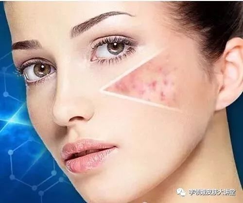 「杏林微资讯」打击痘印，趁早行动！