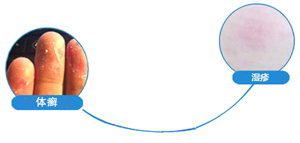 藿香正气水能治湿疹和体癣吗,体癣神经性皮炎湿疹不能吃什么