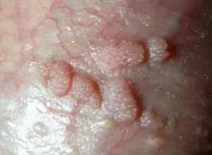 预防宫颈癌从接种hpv疫苗开始,预防宫颈癌需要打针吗