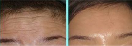 抬头纹与心血管疾病的关系,抬头纹越多心血管越大越好