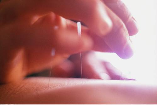 为什么针灸可以减肥,针灸减肥看着瘦了不掉秤