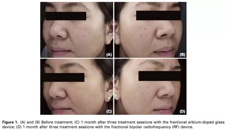 痘印特效药,斑点痘印的克星