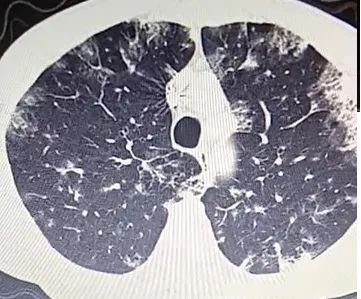 每日咳嗽是什么原因,每日咳痰