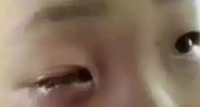 6岁孩子眼球10分钟被融化,7岁孩童几秒眼睛被溶化