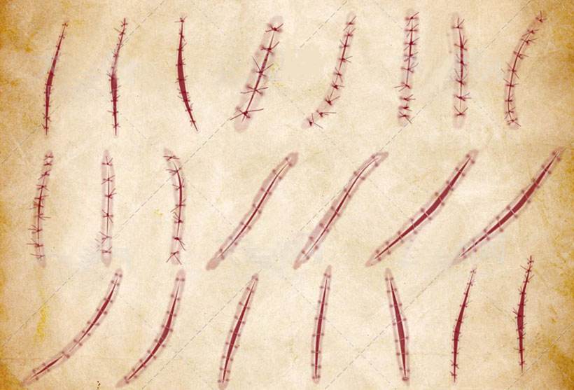 权威研究结果显示：手术后，很可能不等伤口拆线，就可以洗澡了