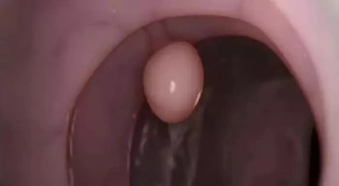 肠息肉和胆囊息肉必须做手术吗,有肠息肉胃息肉胆囊息肉怎么办