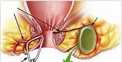 肛门附近脓包溃烂后形成肛瘘吗？