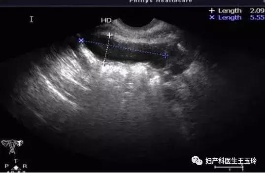 无孔腹腔镜手术,单孔腹腔镜手术如何做