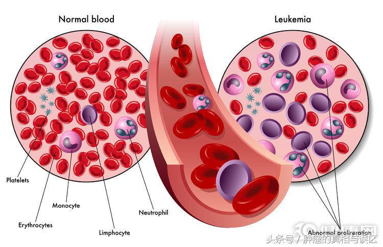 得白血病人的共同特点,白血病人血常规有什么特征