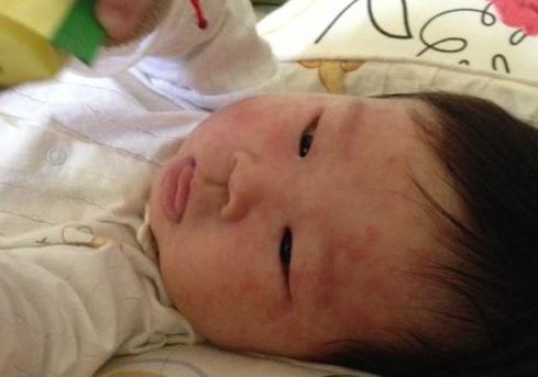 七个半月婴儿急疹症状及护理方法,婴儿急疹需要注意什么事项