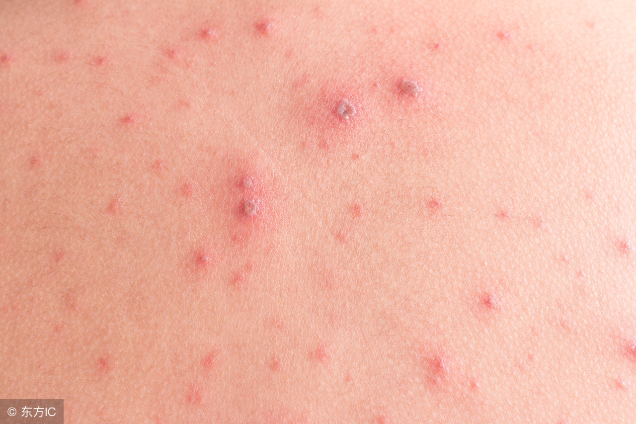 啥叫皮疹症状是啥样的,儿童嘴角红斑样皮疹