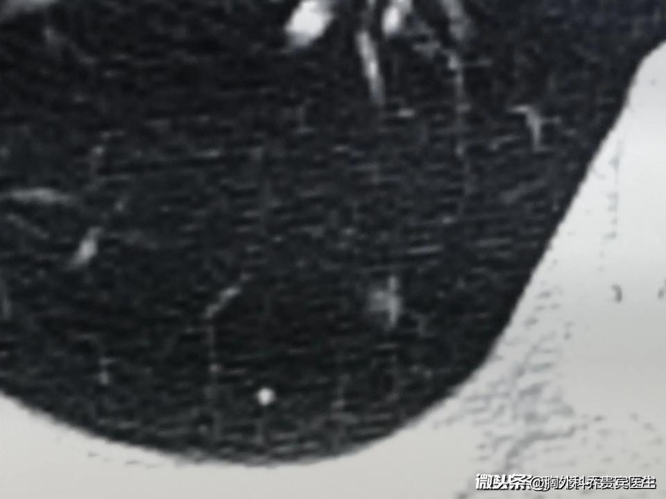 检查发现有肺结节怎么办,肺有索条影及散在结节影吃什么药