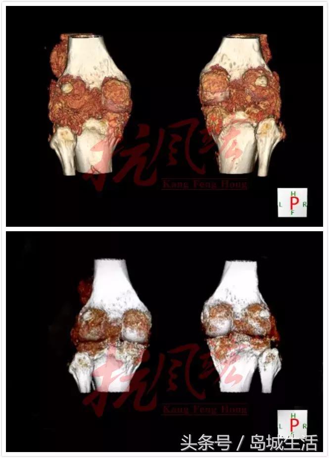 痛风久治不愈怎么办,痛风治疗这四件事真的很重要