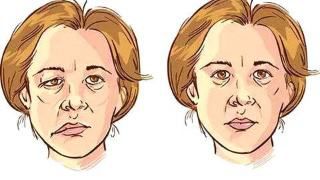 扒一扒如雷贯耳的“肉毒素”浙医四院老患者特别钟爱它的原因是……