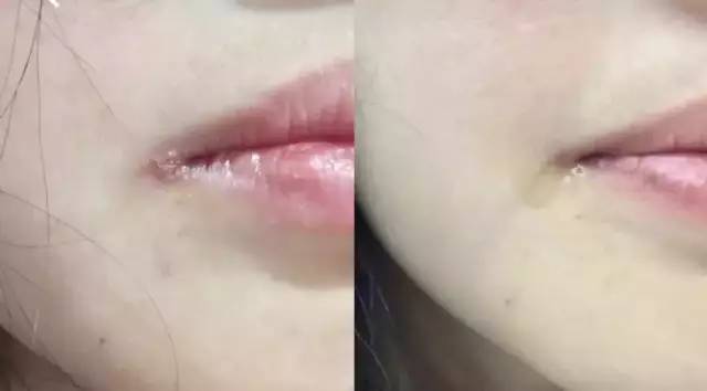 秋冬嘴角干燥、脱皮、发炎？涂点这个，立刻还你幼嫩双唇，让人想要一亲芳泽！