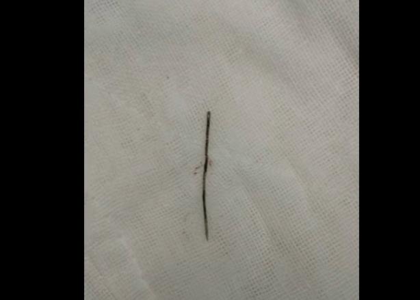 两岁半宝宝体内藏针,两岁儿童缝衣针