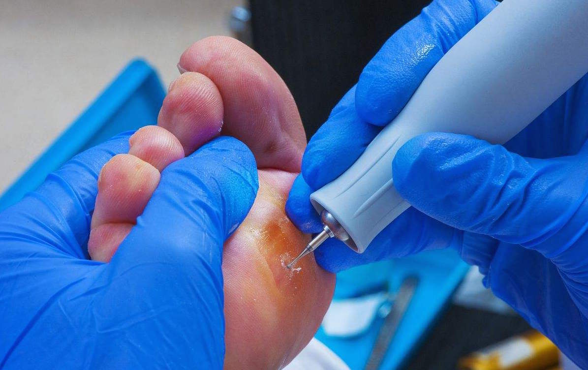 长鸡眼可以跑步吗,有鸡眼跑步注意事项