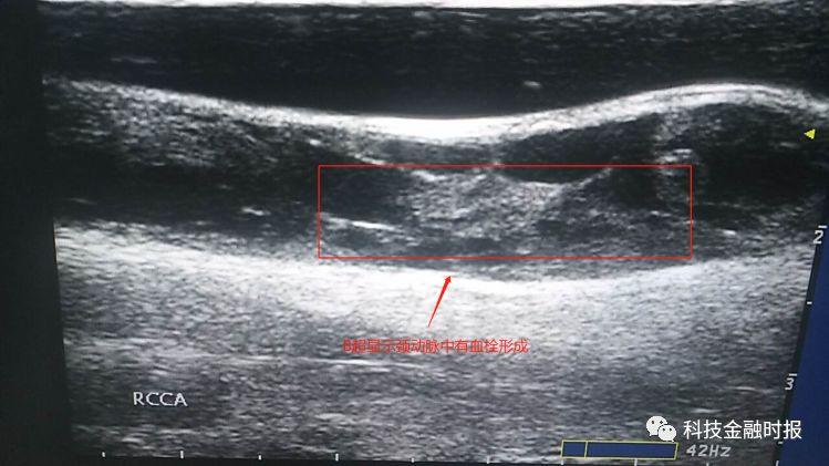 落枕跟动脉夹层,脖子僵硬麻木是颈动脉夹层吗