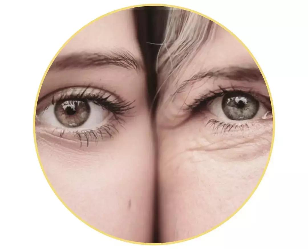 解决黑眼圈细纹最有效的方法,黑眼圈细纹比较严重怎么办