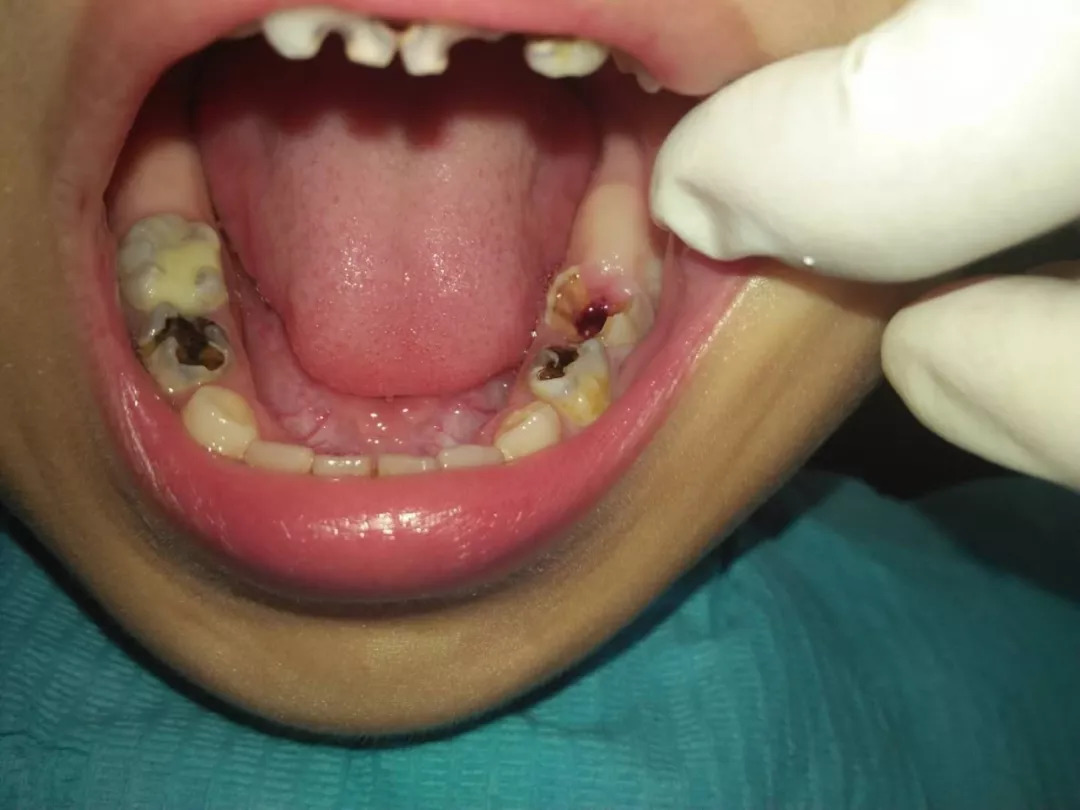 小孩蛀牙影响到牙神经了怎么办,儿童蛀牙疼痛可以杀死牙神经吗