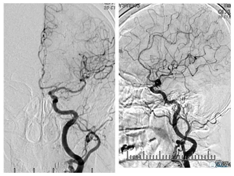 基底动脉重度狭窄介入治疗的风险,椎基底动脉重度狭窄的保守治疗