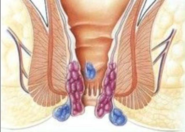 有痔疮上完大便后用毛巾热敷吗,有痔疮的人用湿纸巾擦屁屁行吗