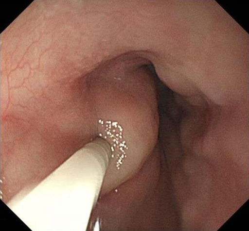肝硬化中西医结合治疗并发症,肝硬化tips介入手术并发症