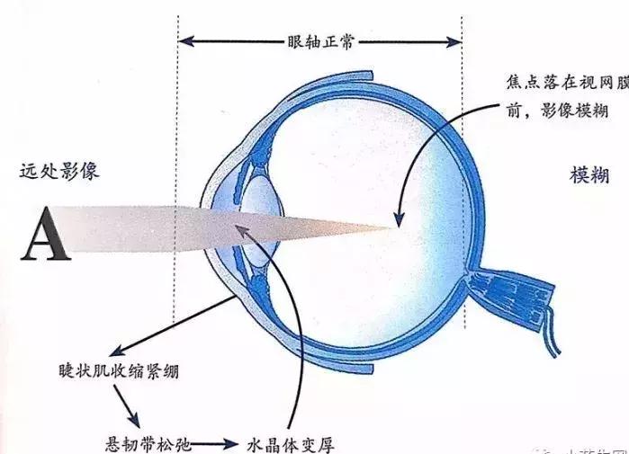 儿童近视7种早期症状,儿童近视的4大早期表现