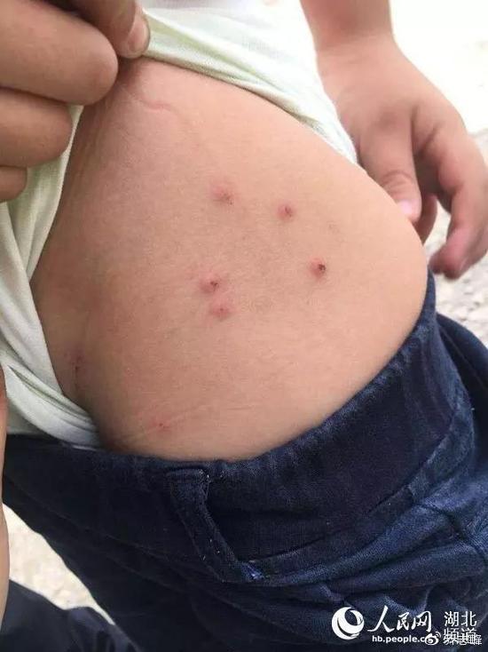 毒跑道症状,如何防止毒跑道