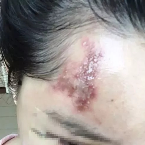 小姐姐割双眼皮失败,做双眼皮赔了一千万