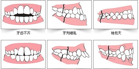 预防儿童龋齿涂氟还是窝沟封闭,有一点龋齿不想做窝沟封闭会怎样
