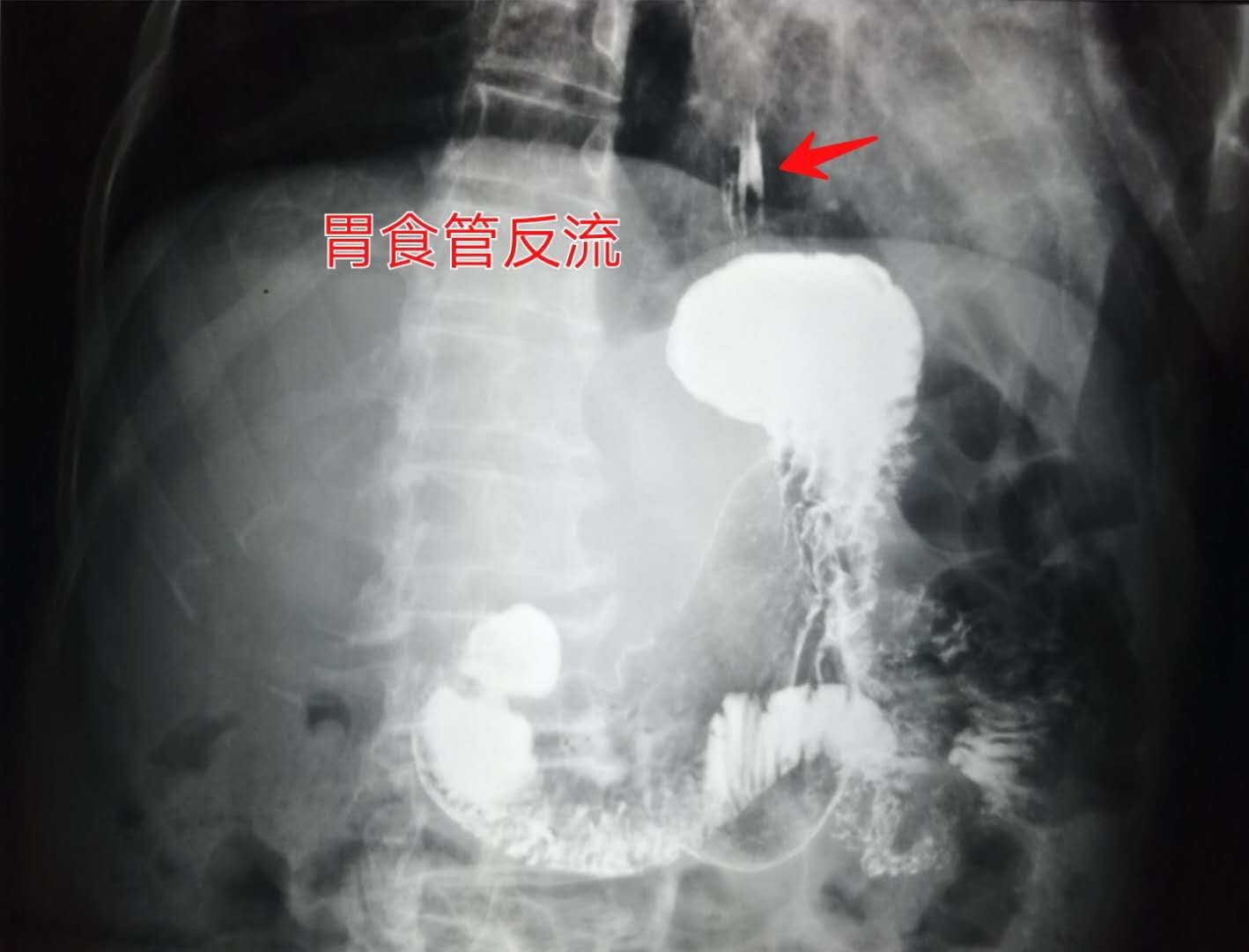 慢性咽炎伴有食道反流该怎么治,慢性咽炎会容易高反吗