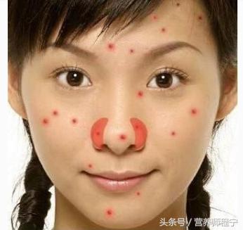 鼻子两边长很大的痘还痛,鼻子两边老是起白痘