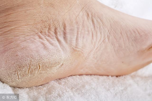 三种脚气治疗方法,根除脚气最科学的方法