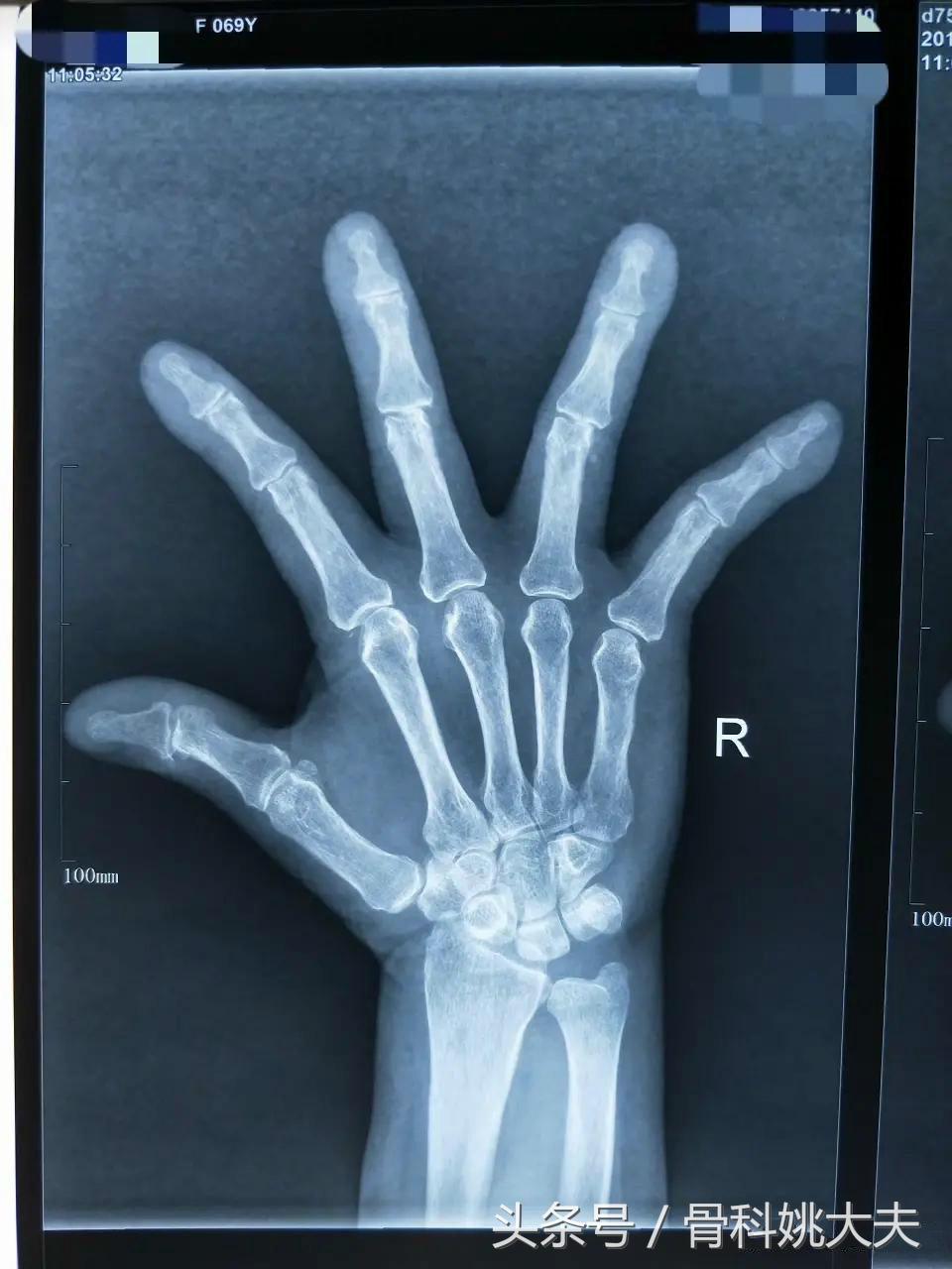 手指关节肥大变形僵硬该吃哪些药,手指第一关节变形凸起是什么病因