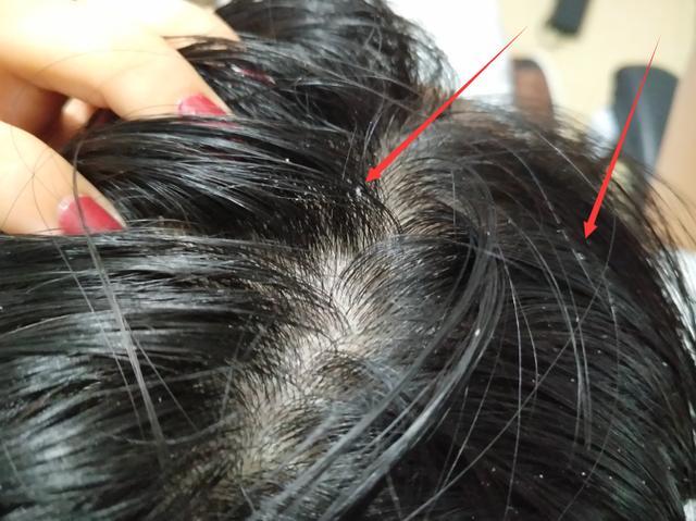 除螨虫最简单方法是什么,螨虫最快最有效的去除方法