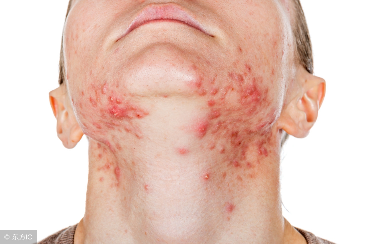 除螨虫最简单方法是什么,螨虫最快最有效的去除方法