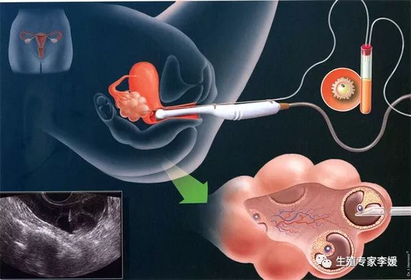 人工授精失败才能做试管吗,人工授精一次失败可以做试管吗