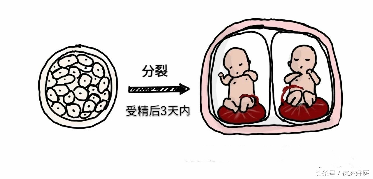 怀双胞胎一个会被另一个吸收吗,双胞胎吃掉另一个胎儿