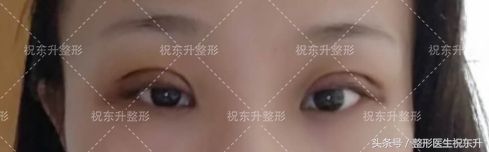 实例：全切双眼皮术后15天变化全程记录