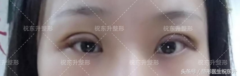 实例：全切双眼皮术后15天变化全程记录