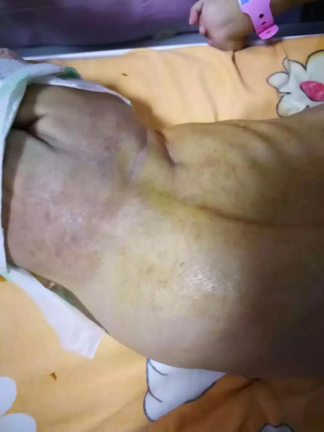 预防红臀的方法,红臀反复怎么处理