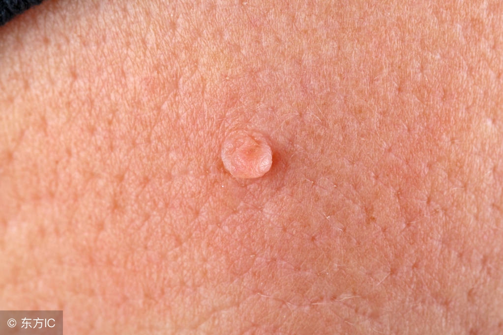 扁平疣擦药膏后脱皮是要好症状吗,皮肤病扁平疣的症状是什么