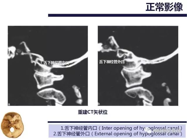 舌下神经和舌咽神经的解剖图,颊神经舌神经解剖图